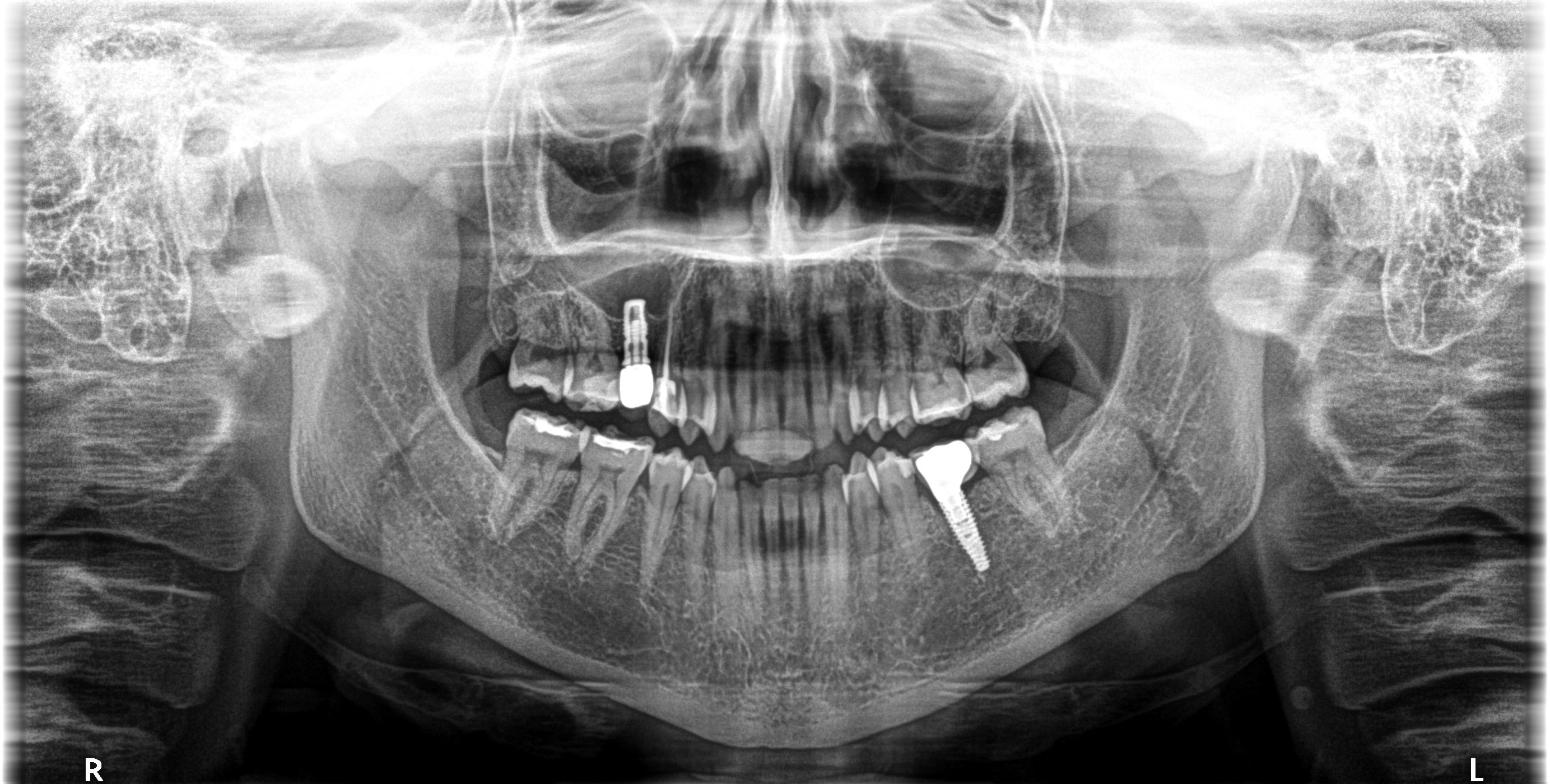 Implantes Dentários em Madrid